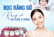Bọc răng sứ