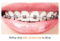Niềng răng mắc cài kim loại tự động tại Nha khoa Đại Phước