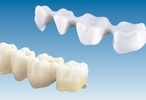 Các loại răng sứ phổ biến hiện nay là những loại nào?