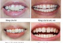 Bảng giá bọc răng sứ tại Nha Khoa Đại Phước