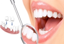 Bọc răng sứ tại Biên Hòa