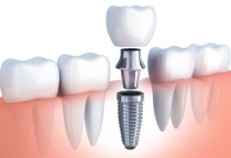 Implant