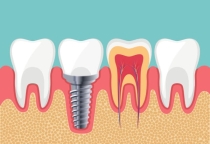Trồng răng implant 