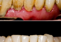 TẠI SAO PHẢI LẤY CAO RĂNG ĐỊNH KỲ ?