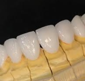 Răng sứ ngọc trai Sapphire