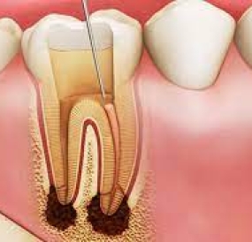 Điều Trị, Chữa Tủy Răng