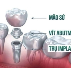 Trồng implant chất lượng cao giá ưu đãi