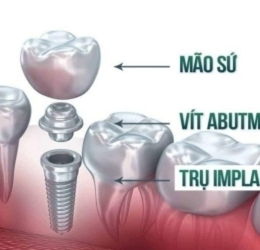 Trồng implant chất lượng cao giá ưu đãi