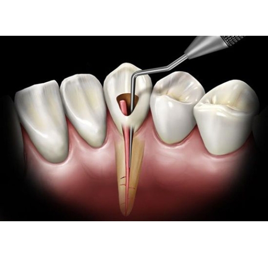 Điều Trị, Chữa Tủy Răng