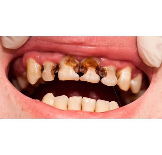 Điều trị sâu răng