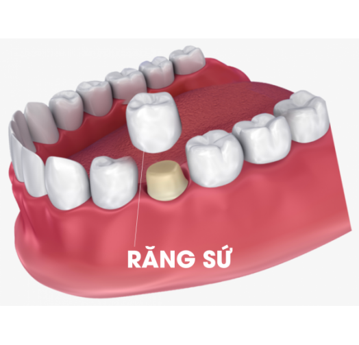 Răng sứ Nacera Q3