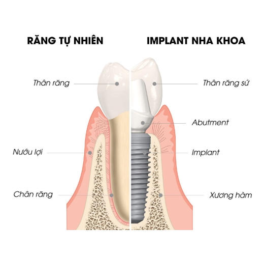Trồng implant chất lượng cao giá ưu đãi