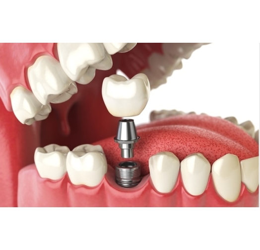 Trồng implant chất lượng cao giá ưu đãi