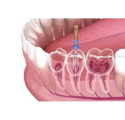Điều Trị, Chữa Tủy Răng