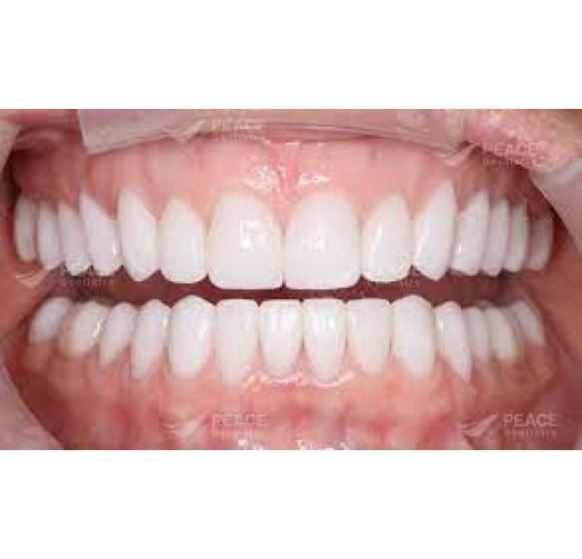 Răng sứ cercon HT