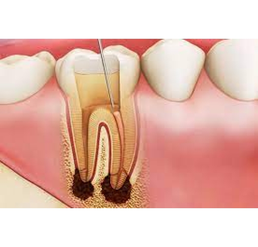 Điều Trị, Chữa Tủy Răng