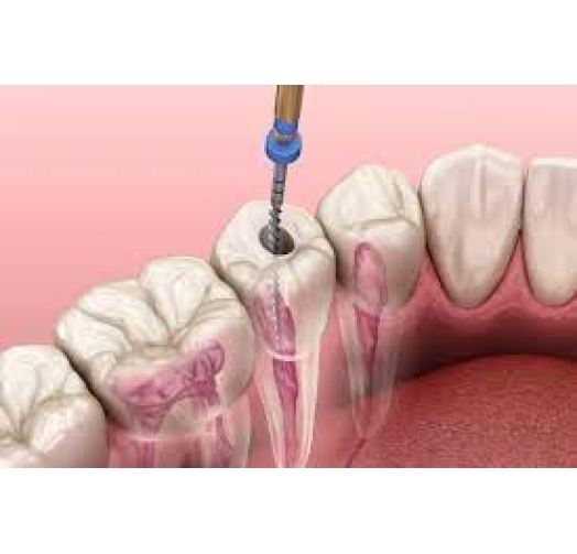 Điều Trị, Chữa Tủy Răng