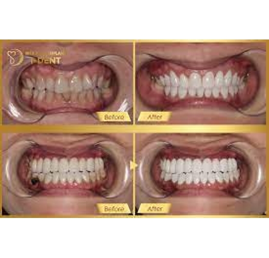 Răng sứ cercon HT