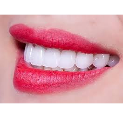 Răng sứ Lavaplus