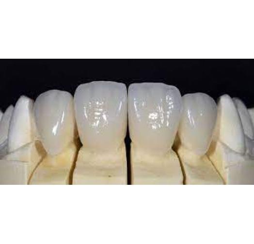Răng sứ Emax