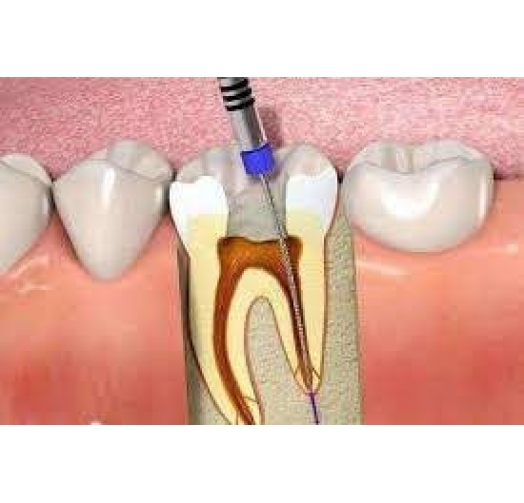 Điều Trị, Chữa Tủy Răng