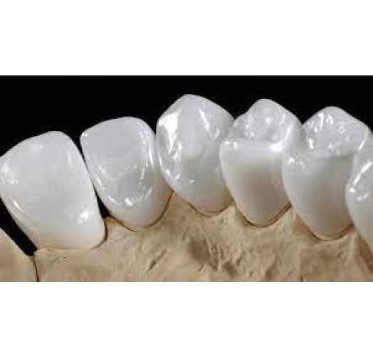 Răng sứ Emax