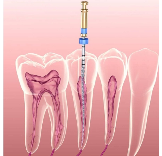 Điều Trị, Chữa Tủy Răng