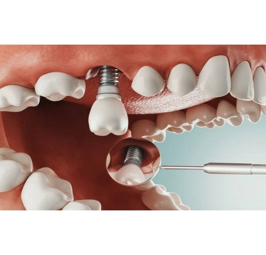 Trồng implant chất lượng cao giá ưu đãi