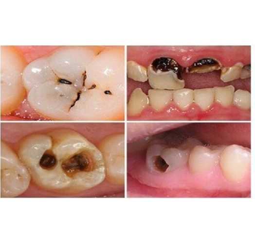 Điều trị sâu răng