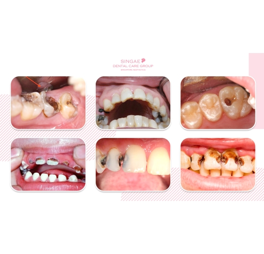 Điều trị sâu răng