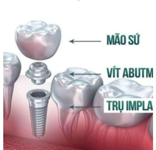 Trồng implant chất lượng cao giá ưu đãi